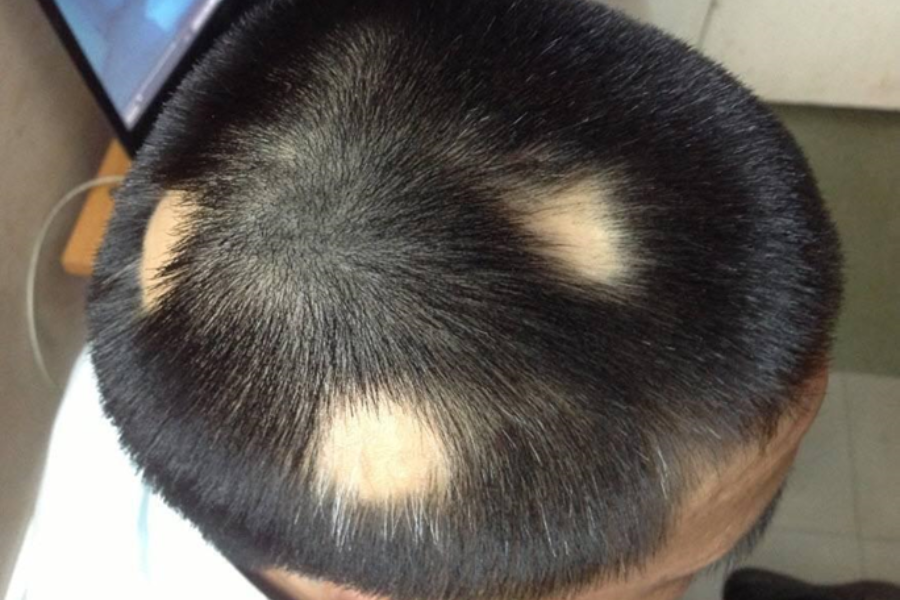 Rụng tóc từng mảng: Phương pháp điều trị hiệu quả theo y học cổ truyền