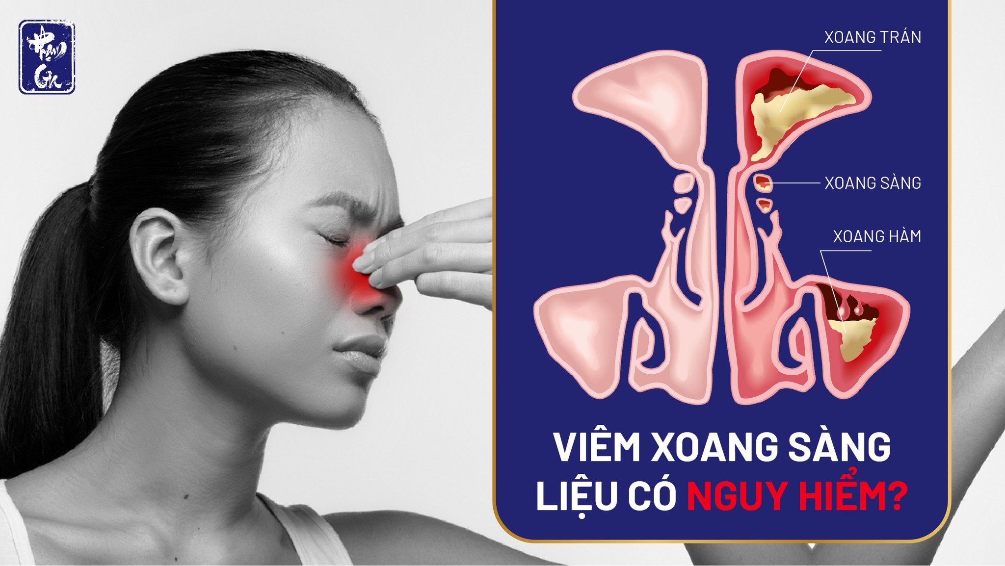 Viêm xoang sàng liệu có nguy hiểm?