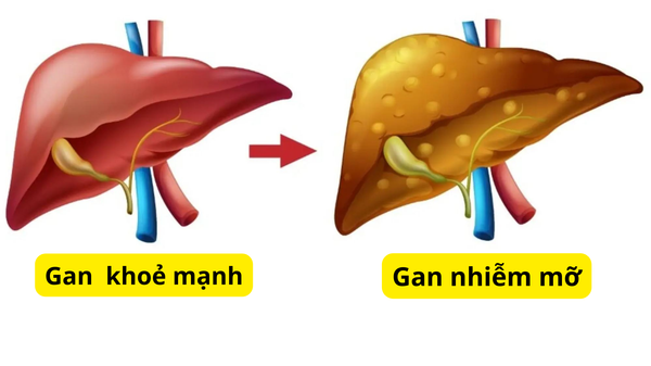 gan-nhiem-mo