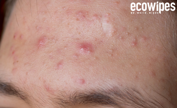 LƯU Ý CHĂM SÓC DA KHI BỊ MỤN NỘI TIẾT