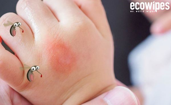 MẸ NÊN LÀM GÌ KHI BÉ BỊ CÔN TRÙNG CẮN?