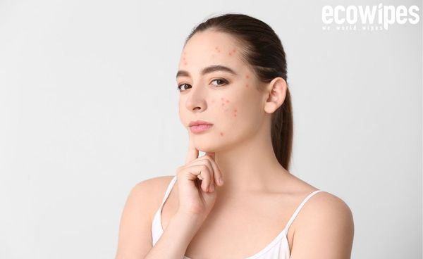 TẠI SAO MÙA HÈ DỄ KHIẾN DA NỔI MỤN?