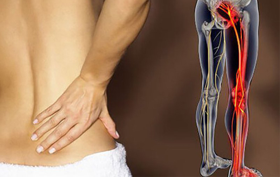 Hướng Dẫn Cách Chữa Trị Bênh Thần Kinh Tọa
