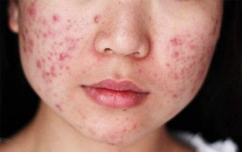 10 Cách Trị Mụn Tại Nhà Hiệu Quả Từ Nguyên Liệu Tự Nhiên