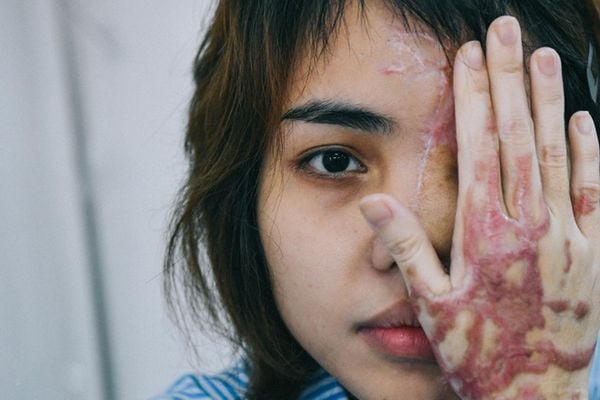 cô gái bị tạt axit