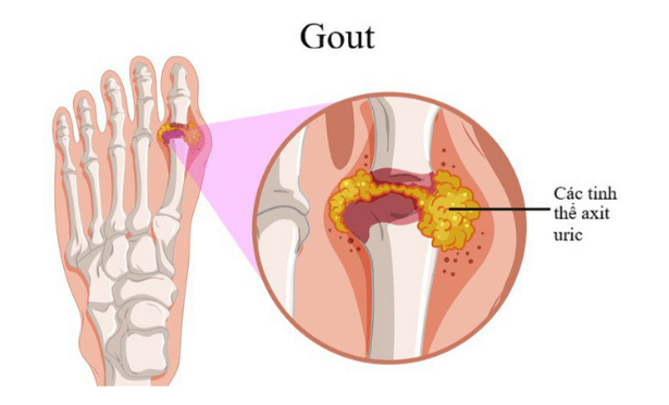 Chế độ ăn dành cho người bị bệnh Gout bạn nên biết