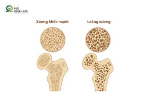 Loãng xương
