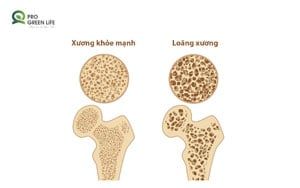 Loãng xương 