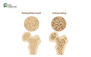 Loãng xương 