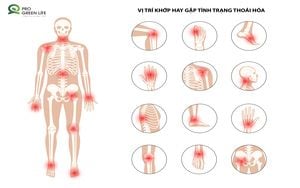 Thoái hóa khớp - đừng xem nhẹ khi đã 