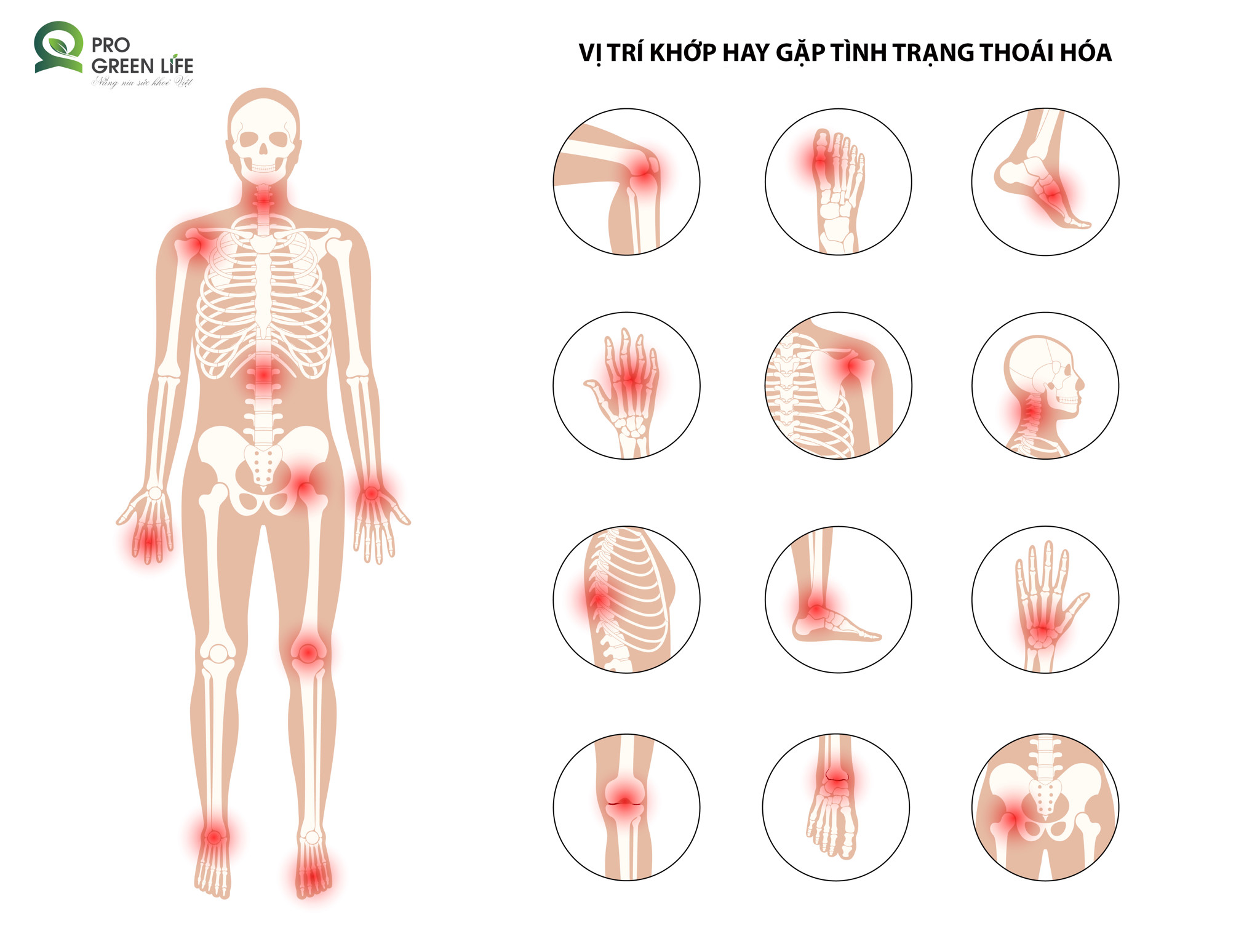 THOÁI HÓA KHỚP - ĐỪNG XEM NHẸ KHI ĐÃ “LÃO HÓA” TỪ BÊN TRONG