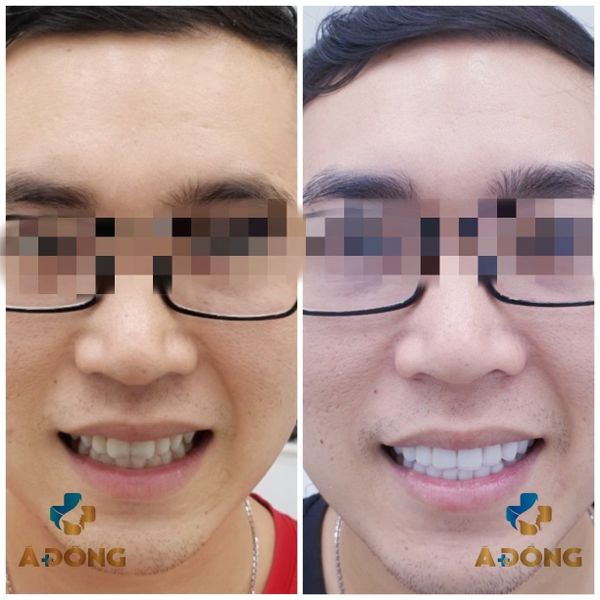 Nụ Cười Toả Nắng , Đẹp Hút Hồn Nhờ Dán Sứ Venner