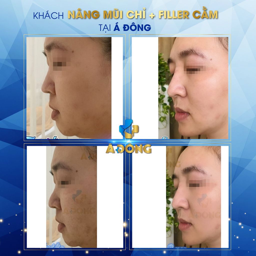 Nâng Mũi Chỉ + Filler Cằm