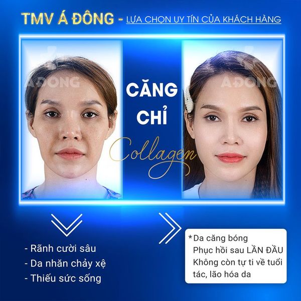 Căng Chỉ Collagen
