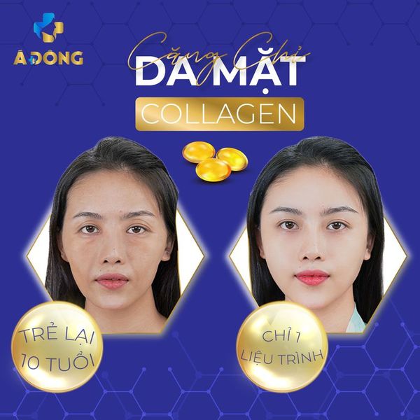 Căng Chỉ Toàn Mặt