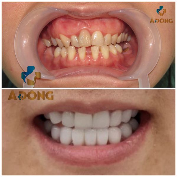 Cận Cảnh Sứ Veneer - Không mài độc quyền Á Đông