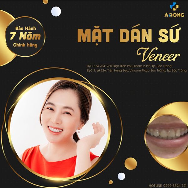 Dán Sứ Veneer- Phương pháp tối ưu để có được nụ cười hoàn hảo