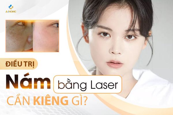 Điều Trị Nám Bằng Laser Cần Kiêng Gì?