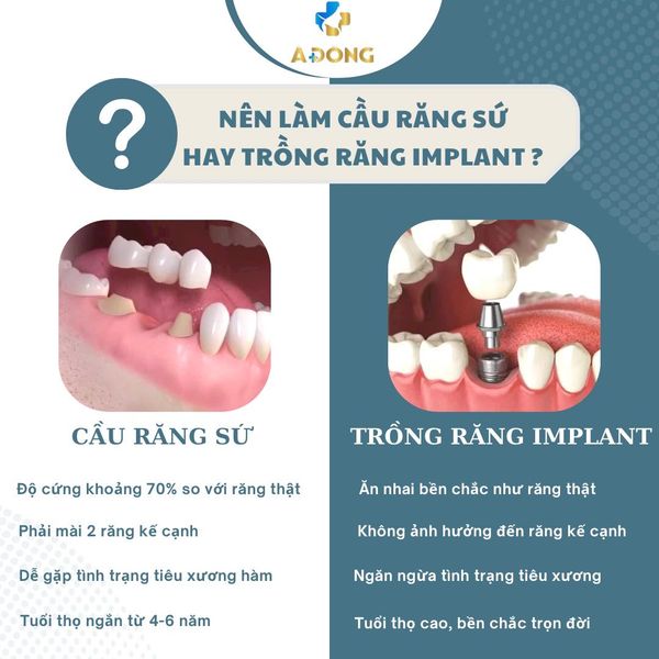 Phục Hình Răng Bị Mất Bằng Phương Pháp 