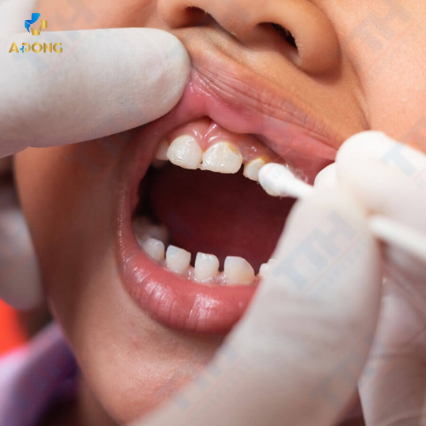 Bôi Fluoride – Bảo vệ răng khỏe, giảm ê buốt cho trẻ em