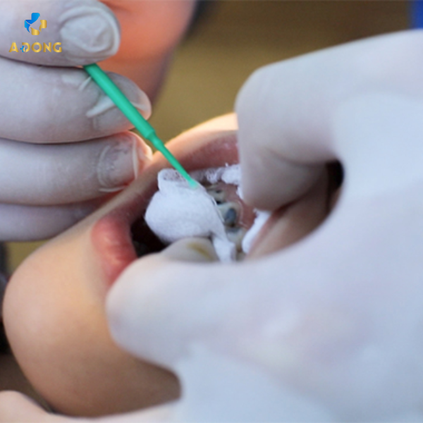 Bôi SDF – Giải pháp ngừa sâu răng an toàn cho trẻ em