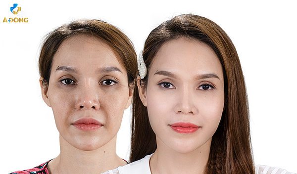 PHƯƠNG PHÁP CĂNG CHỈ COLLAGEN LÀ GÌ? CÓ TÁC DỤNG GÌ?