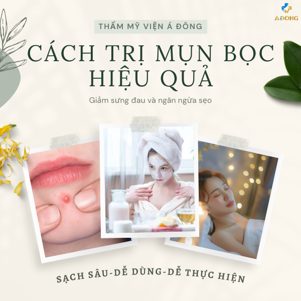 Cách trị mụn bọc hiệu quả, giảm sưng đau và ngăn ngừa sẹo