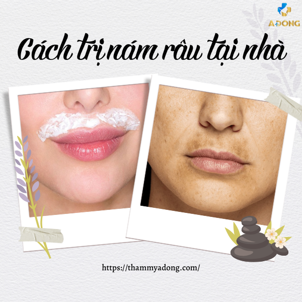 Cách trị nám râu tại nhà đơn giản và hiệu quả từ A-Z
