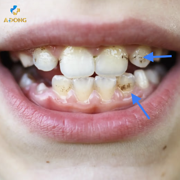 Lấy cao răng trẻ em – Bảo vệ nụ cười khỏe mạnh cho bé