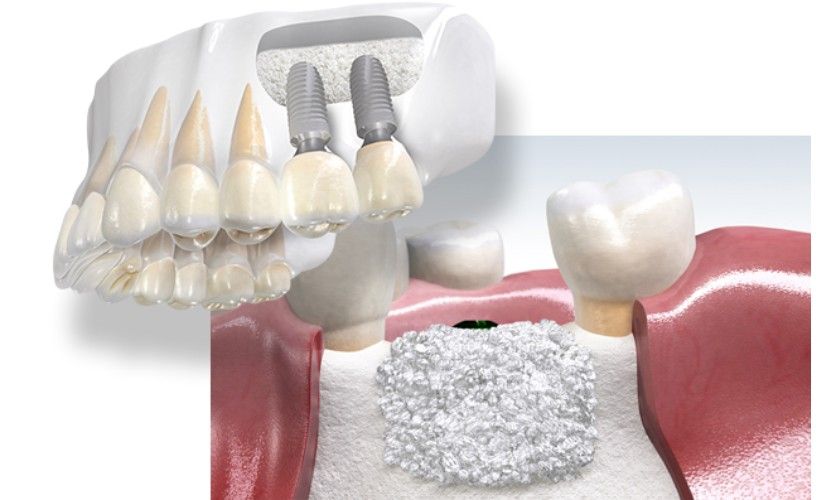 Tiêu chí đánh giá xương hàm đạt tiêu chuẩn để trồng Implant