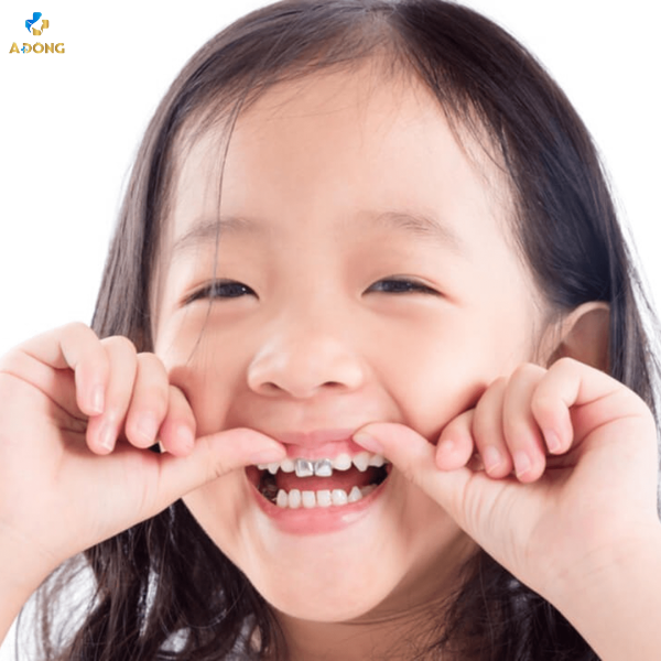 Phương pháp chụp mão kim loại có sẵn răng sữa cho trẻ