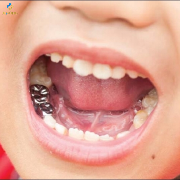 Phương pháp chụp mão kim loại cho răng sữa cho trẻ