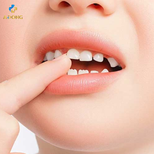 Chăm sóc và điều trị tủy răng cửa (răng sữa) R2-3 cho trẻ