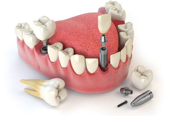 Top 3 loại implant phổ biến hiện nay