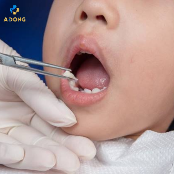 Dịch vụ nhổ răng sữa an toàn – bé không còn sợ tại Á Đông