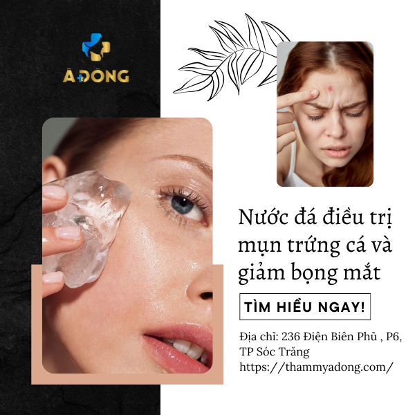 Có thật sự nước đá điều trị mụn trứng cá và giảm bọng mắt?