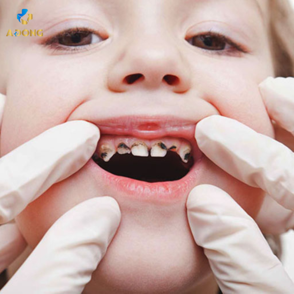 Dịch vụ trám răng sữa bị sâu an toàn và hiệu quả cho trẻ
