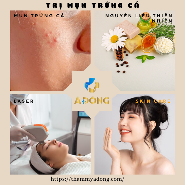 Bí quyết trị mụn trứng cá tuổi dậy thì hiệu quả và an toàn