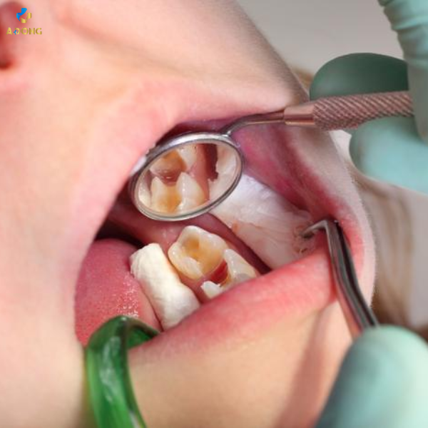 Điều trị tủy răng sữa vùng R4-5 bảo vệ sức khỏe răng miệng cho bé