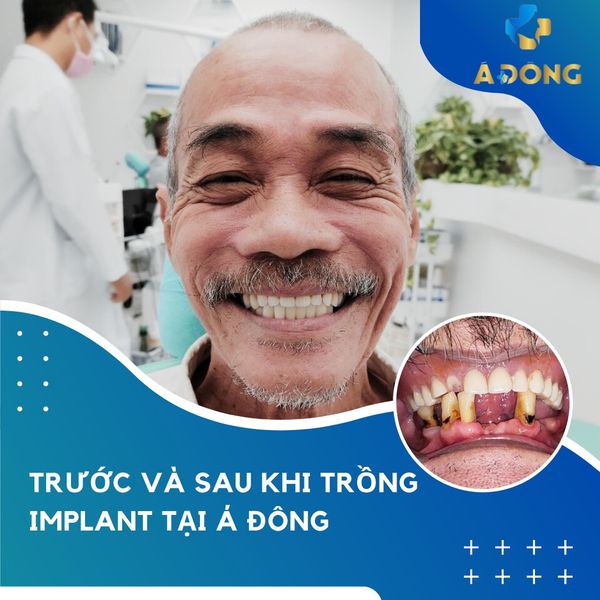 Cấy ghép răng implant