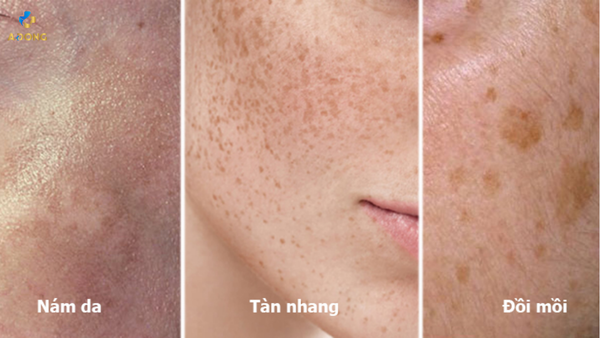 trị nám bằng laser tại Thẩm mỹ viện Á Đông hieu qua ngay lap tuc