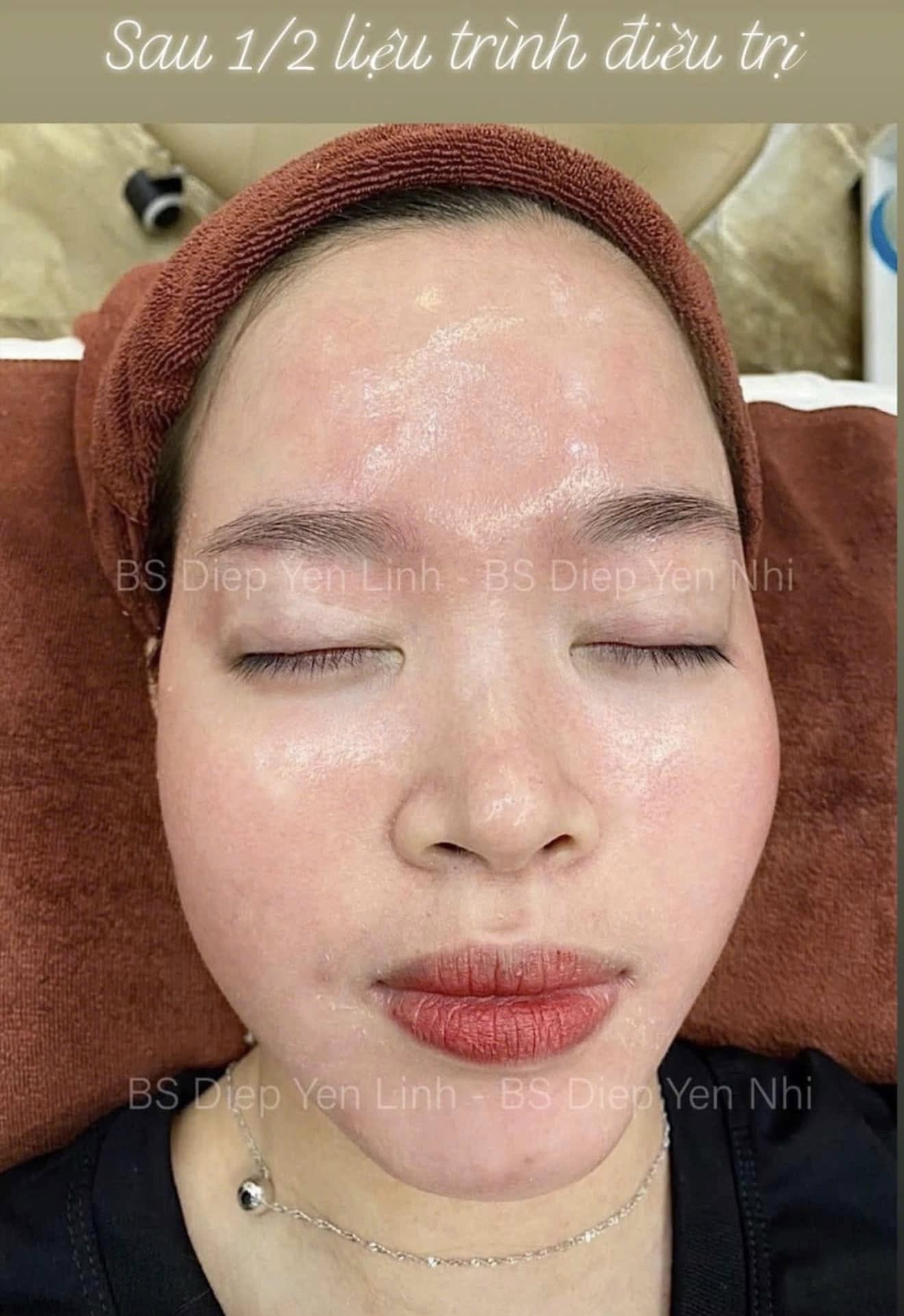 RETINOIDS CÓ DÙNG ĐƯỢC CHO DA NHẠY CẢM, DA THƯỜNG KHÔNG?