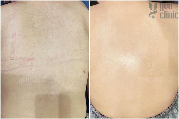 ĐIỀU TRỊ DA BODY DỄ HAY KHÓ?