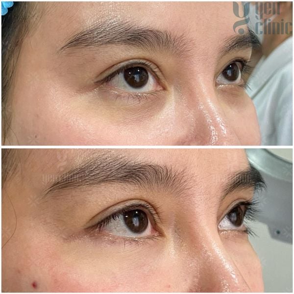 ĐIỀU TRỊ TRẺ HOÁ VÙNG DƯỚI MẮT