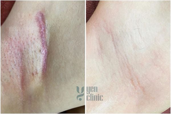 ĐIỀU TRỊ SẸO CHẤN THƯƠNG, SAU PHẪU THUẬT