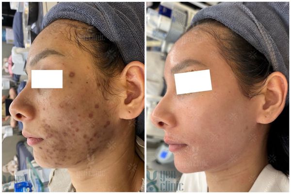 GIẢI CỨU LÀN DA BỊ TAI BIẾN