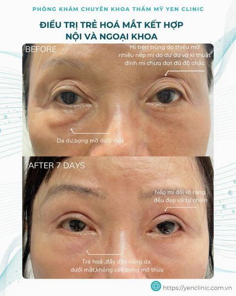 Mí mắt nào có thể làm khó phẫu thuật viên?