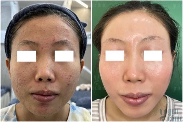 Hành trình 12 tuần phục hồi sức khoẻ da