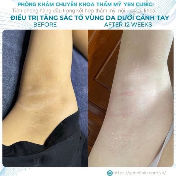 Phục hồi sức khoẻ vùng da dưới cánh tay
