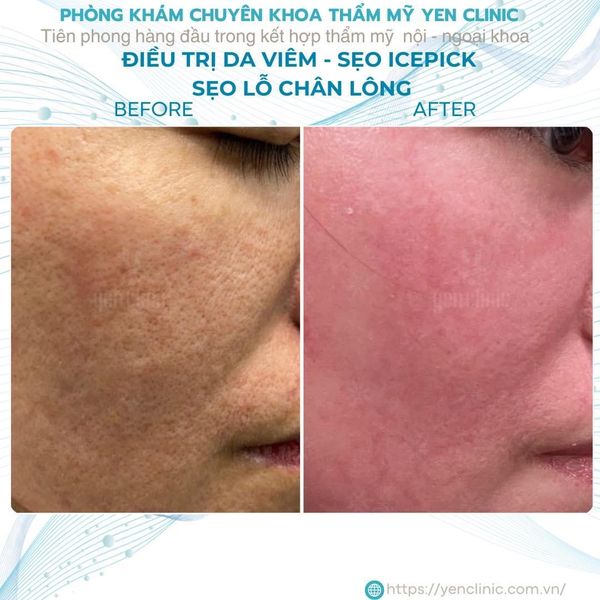 Chuẩn bị da quan trọng đến mức nào trong điều trị sẹo